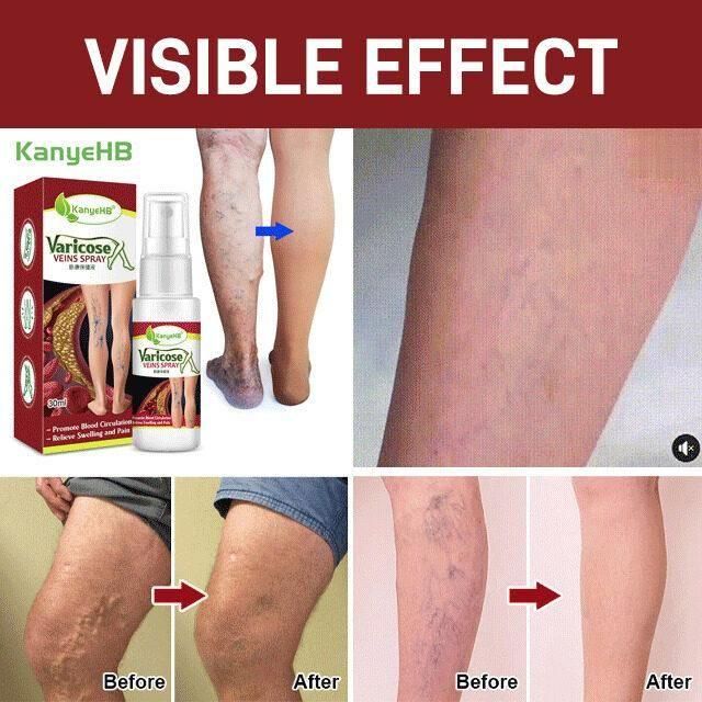 Buy The New Vein Healing Varicose Veins Treatment Spray - BestCart