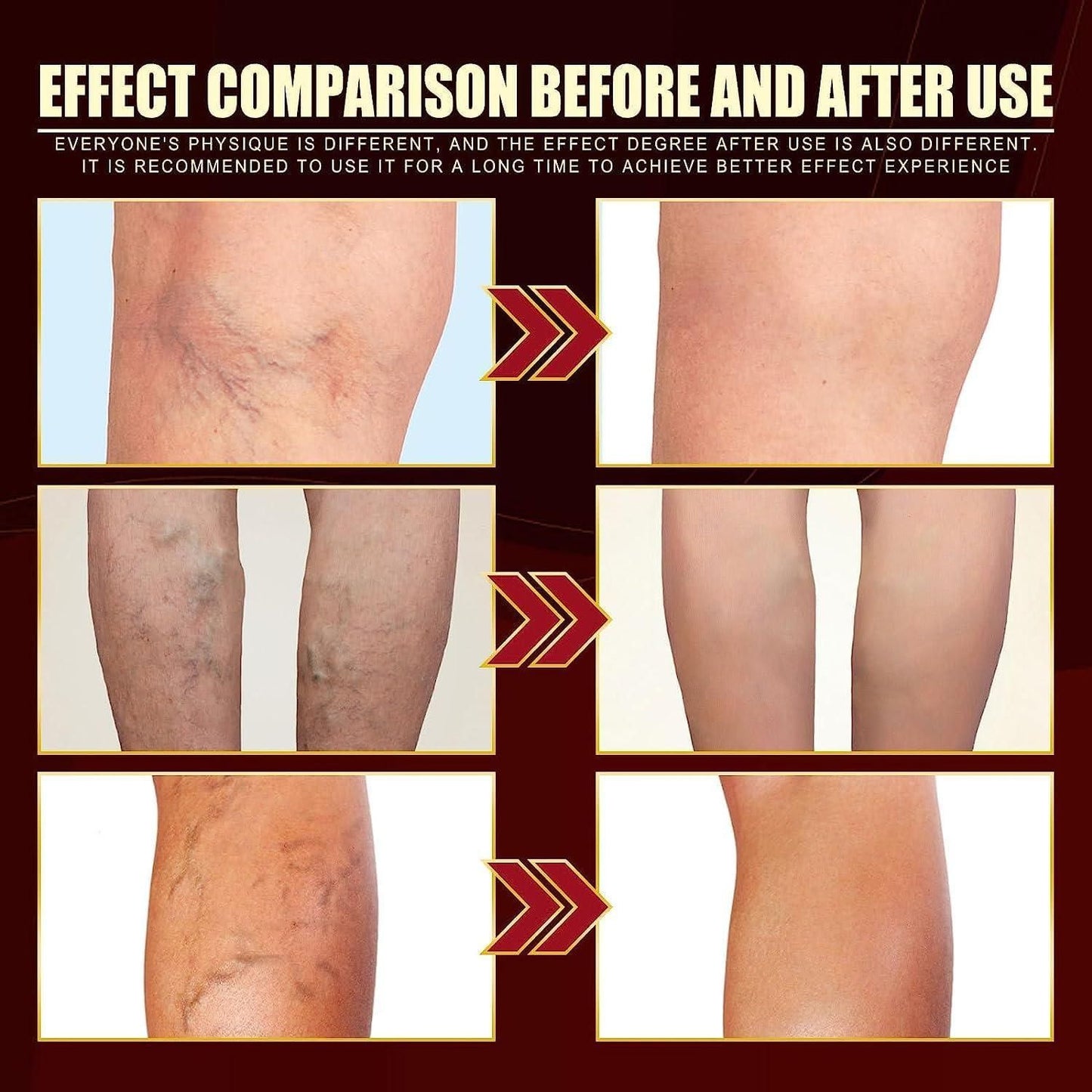 Buy The New Vein Healing Varicose Veins Treatment Spray Pack of 2 - BestCart