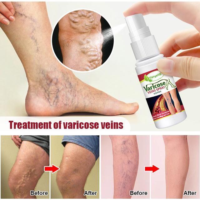 Buy The New Vein Healing Varicose Veins Treatment Spray - BestCart