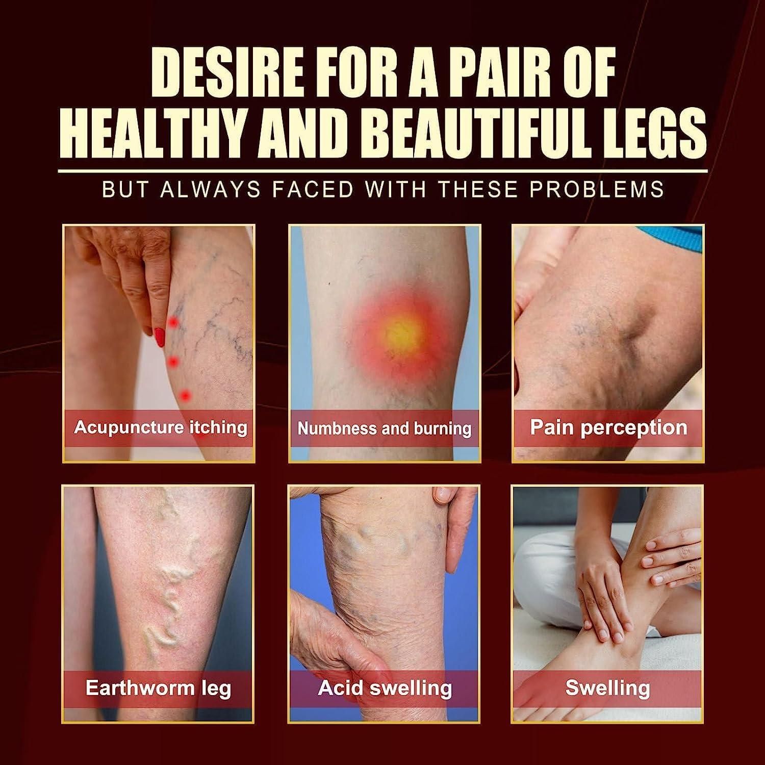 Buy The New Vein Healing Varicose Veins Treatment Spray Pack of 2 - BestCart