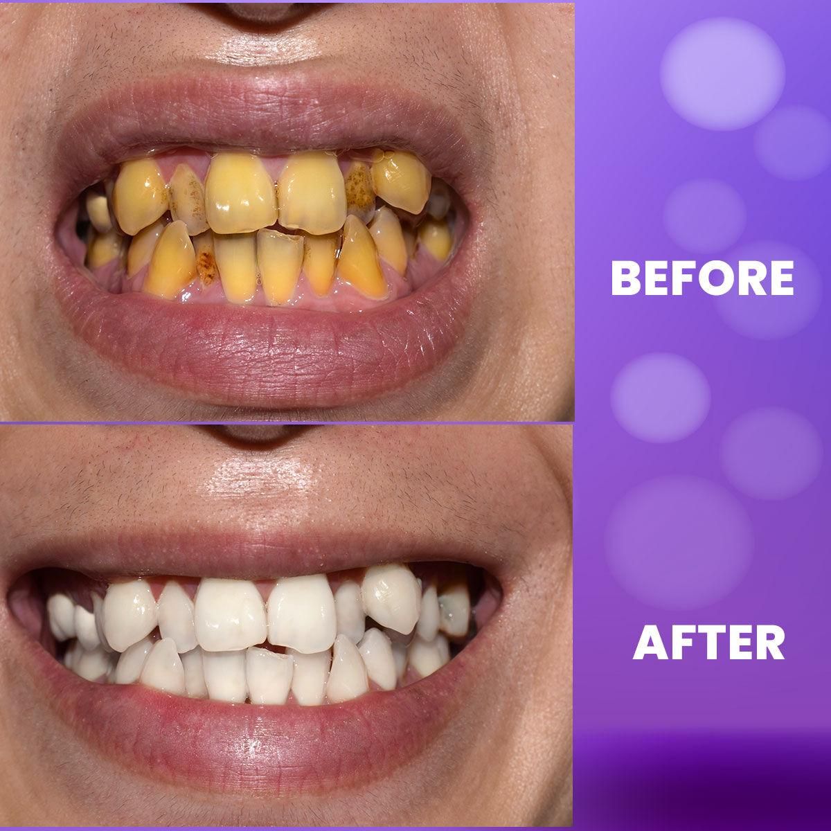 Buy The New Purple Teeth Whitening Gel - BestCart