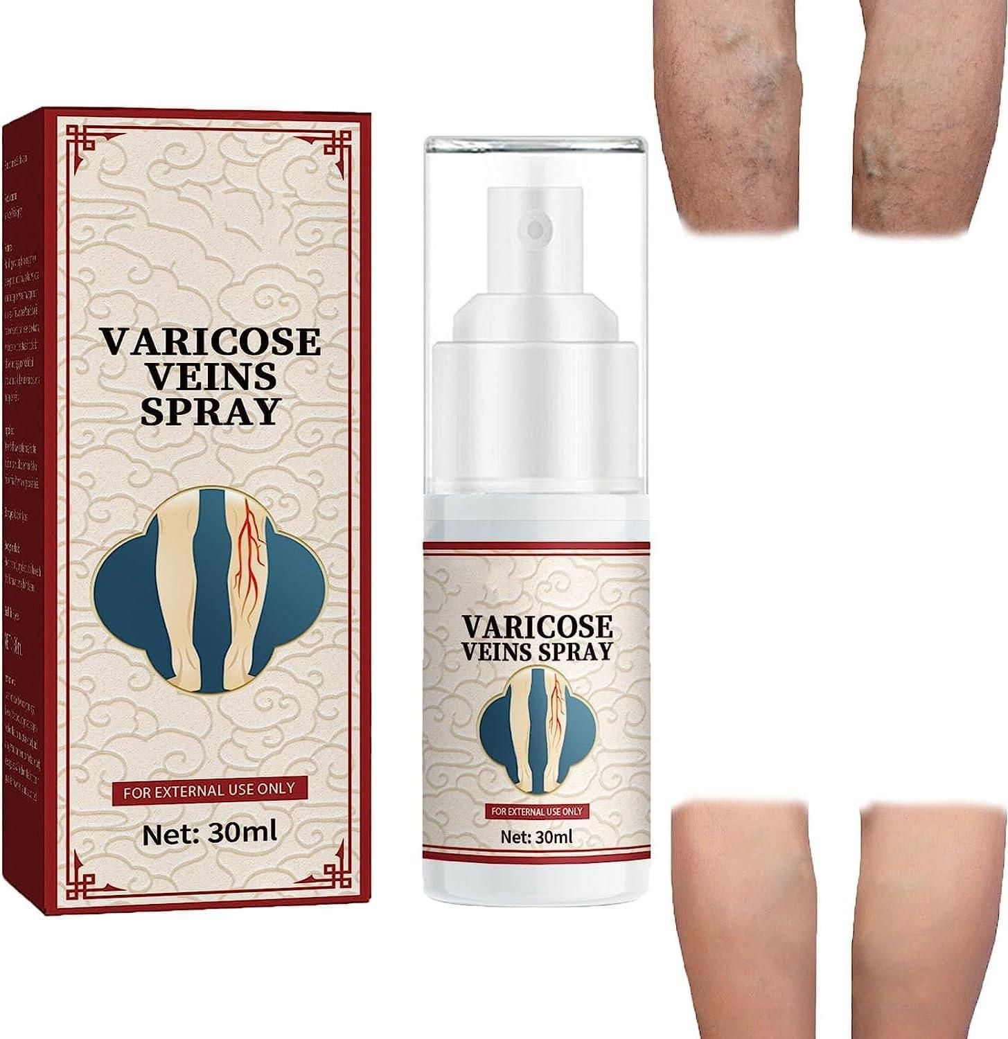 Buy The New Vein Healing Varicose Veins Treatment Spray Pack of 2 - BestCart