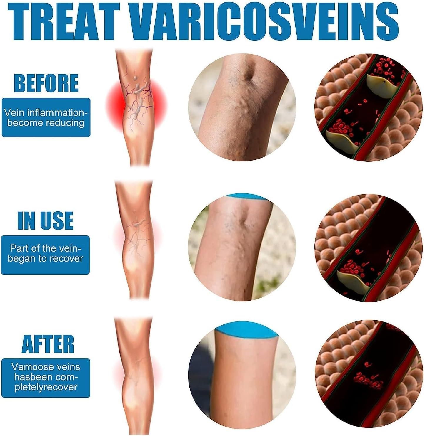 Buy The New Vein Healing Varicose Veins Treatment Spray Pack of 2 - BestCart