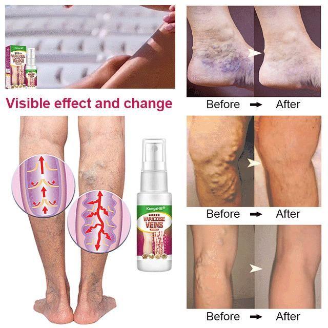 Buy The New Vein Healing Varicose Veins Treatment Spray - BestCart